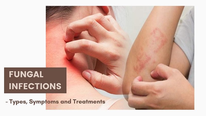Two images show a person scratching itchy, red rashes on their neck and arm. Text reads "FUNGAL INFECTIONS: Types, Symptoms and Treatments".
