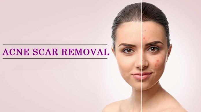 A split image shows a woman's face before (left, with acne scars) and after (right, with clear skin) acne scar removal treatment. Text reads "ACNE SCAR REMOVAL".