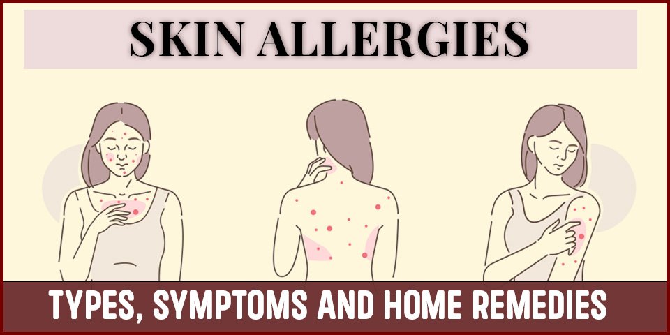 Illustrations show three women with red rashes on their face, chest, back, and arms. Text reads "SKIN ALLERGIES: TYPES, SYMPTOMS AND HOME REMEDIES".