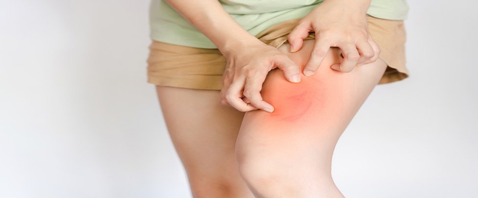 A person scratches a red, itchy rash on their upper thigh.