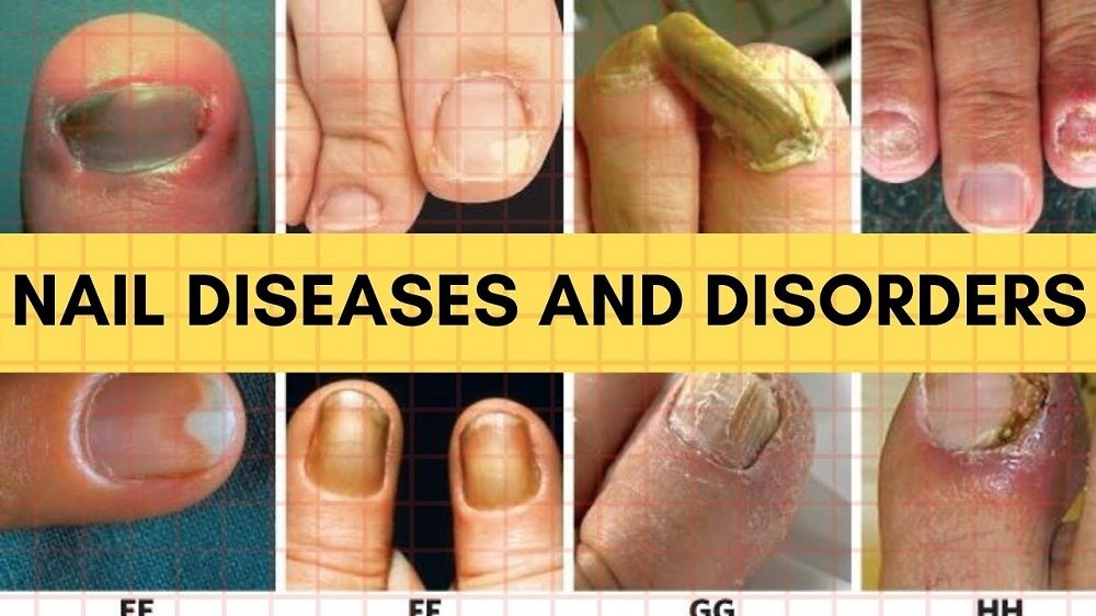 A collage of eight close-up images showing various nail diseases and disorders on fingers and toes. A yellow bar contains the text "NAIL DISEASES AND DISORDERS".