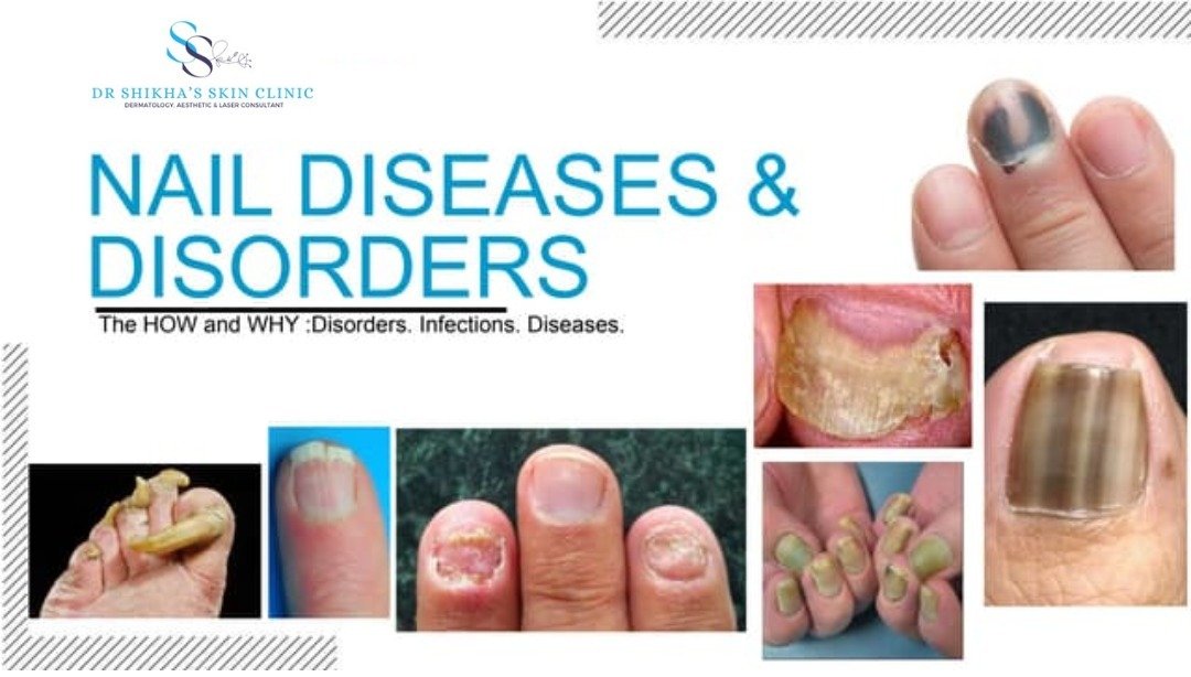 A collage of images shows various nail diseases and disorders on fingers and toes. Text reads "NAIL DISEASES & DISORDERS: The HOW and WHY: Disorders. Infections. Diseases." The logo and name of Dr Shikha's Skin Clinic are also included.