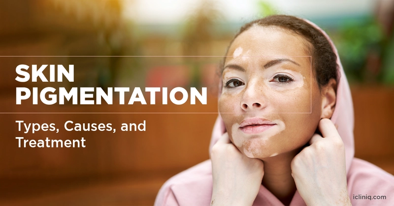 A woman with patches of lighter skin (vitiligo) is shown next to text about "SKIN PIGMENTATION: Types, Causes, and Treatment"