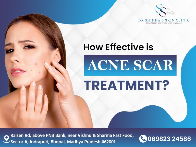 A woman with acne scars looks concerned and touches her cheek. Text asks "How Effective is ACNE SCAR TREATMENT?". The logo and name of Dr Shikha's Skin Clinic, Bhopal address, and phone number are also included.