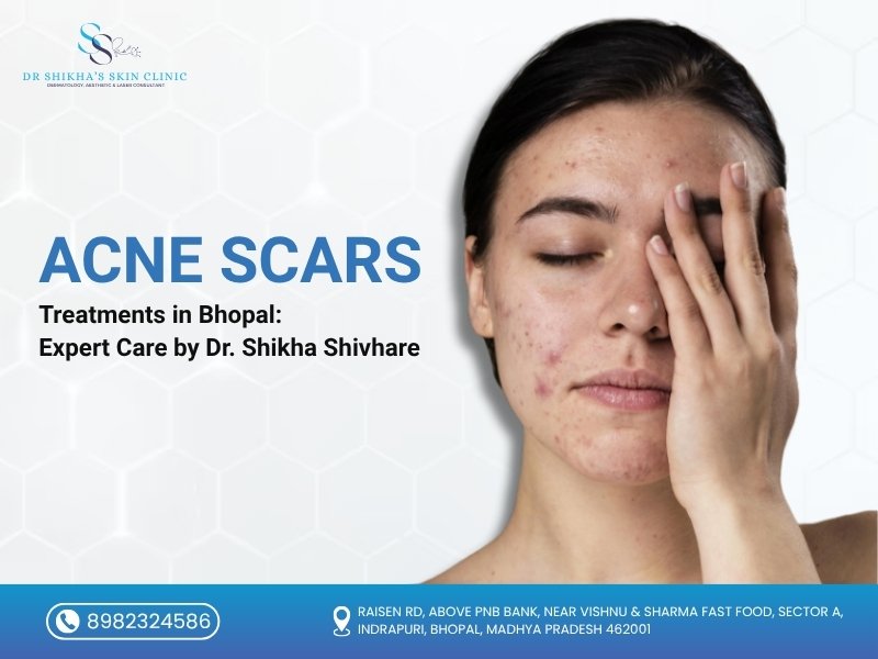 Close-up of a young woman with acne scars on her face, covering one eye with her hand, promoting acne scars treatments in Bhopal by Dr. Shikha Shivhare at Dr. Shikha’s Skin Clinic.
