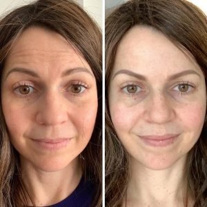 A split image shows a woman's face before (left, with wrinkles) and after (right, with fewer wrinkles and smoother skin) anti-aging treatment. The panels are labeled "BEFORE" and "AFTER".