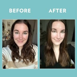 A split image shows a woman's face before (left, with dark spots and uneven tone) and after (right, with clearer, brighter, and more even-toned skin) treatment. The panels are labeled "BEFORE" and "AFTER".