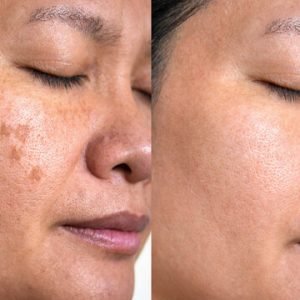 A split image shows a person's face before (left, with dark pigmentation and spots) and after (right, with clearer, more even-toned skin) pigmentation treatment.