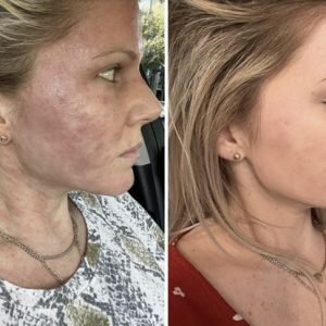 A split image shows a woman's face and neck before (left, with redness and irritation) and after (right, with clearer, calmer skin) treatment.